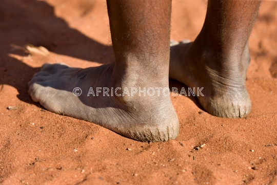 Woman with cracked heels 